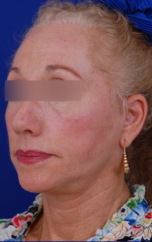 female facelift