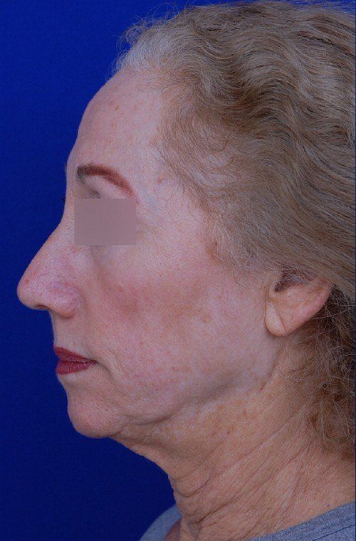 female facelift