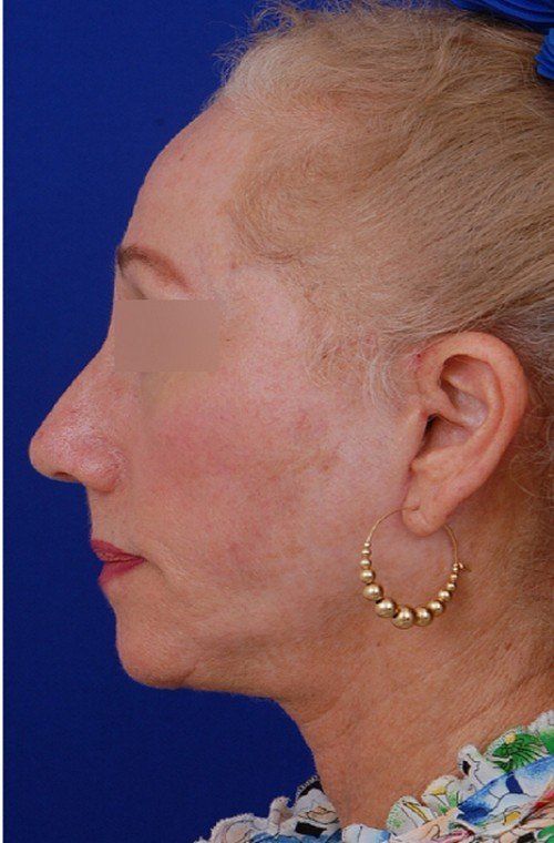 female facelift