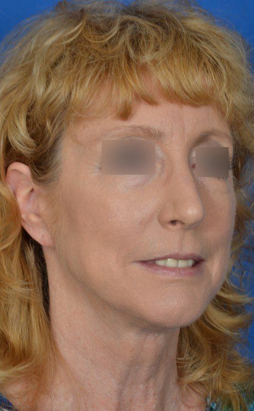 mini facelift before and after