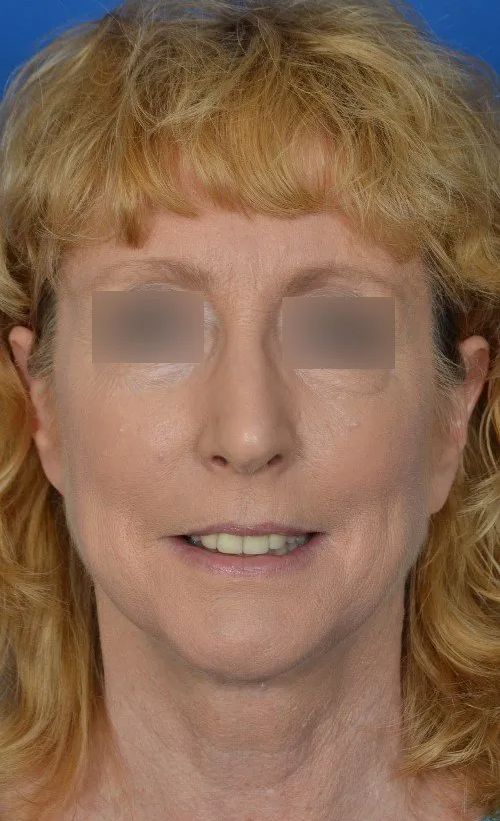 mini facelift before and after