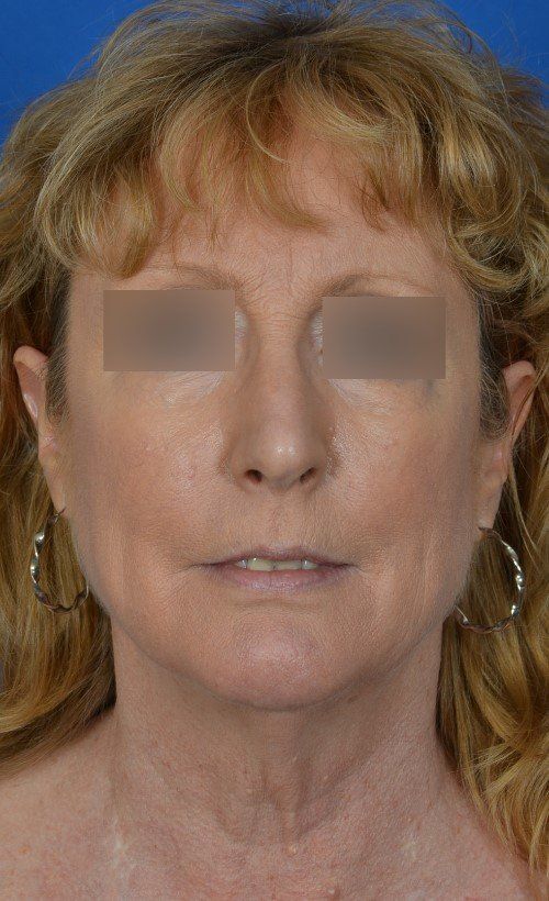 mini facelift before and after
