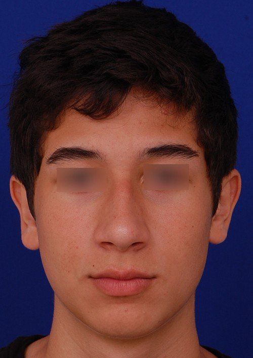 before chin implant