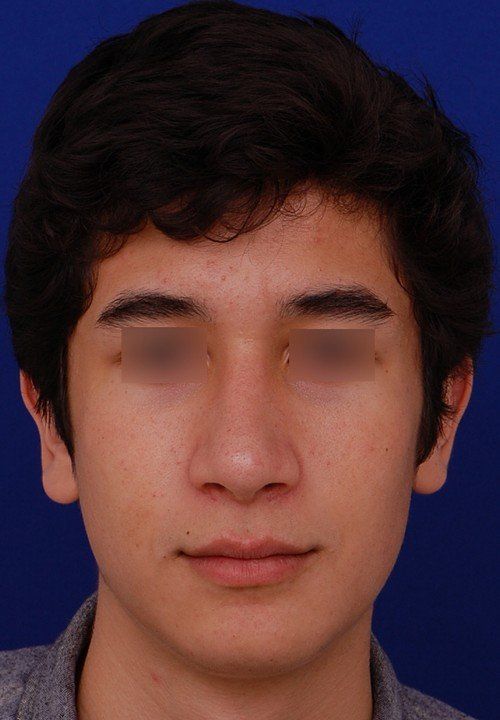 after chin implant