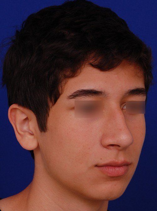 before chin implant