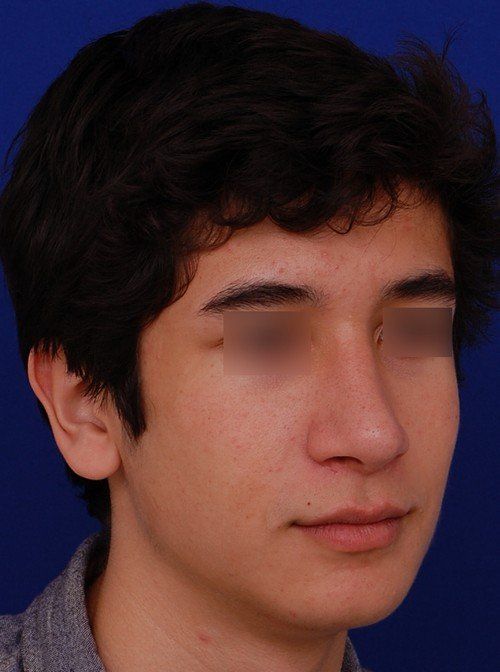 after chin implant