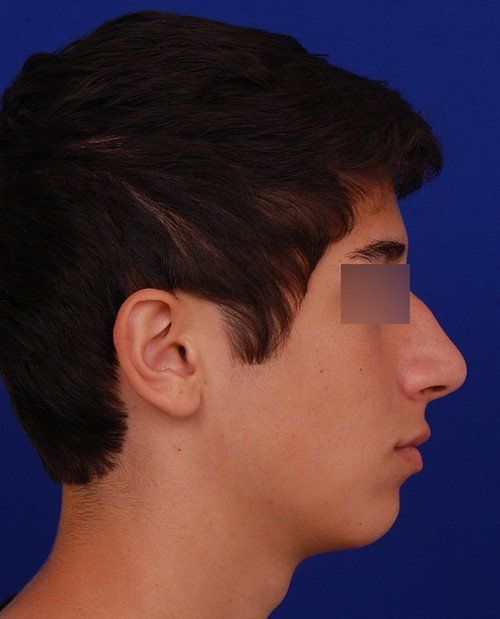 male chin implant example