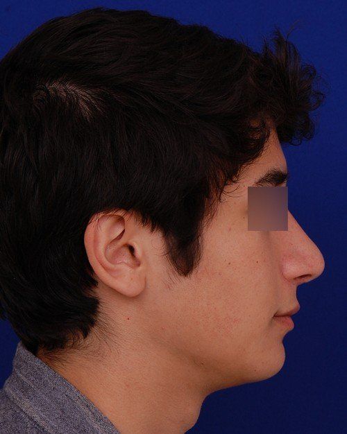 male chin implant example