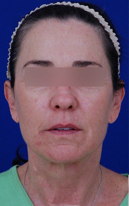 female facelift