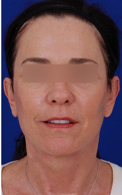 female facelift