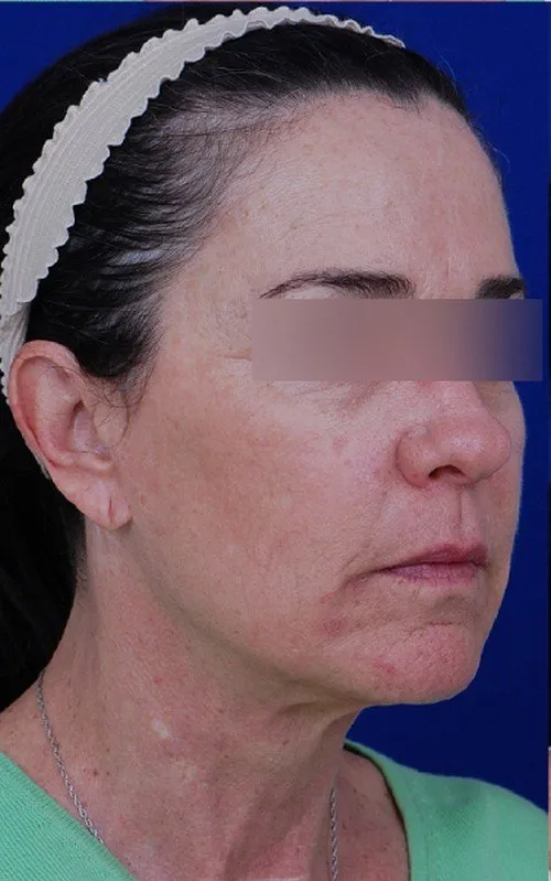 female facelift