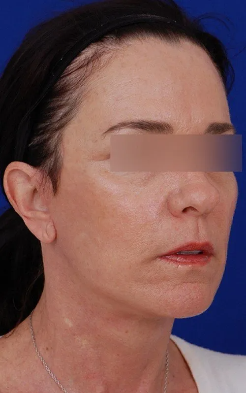 female facelift