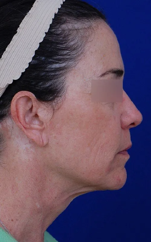 female facelift