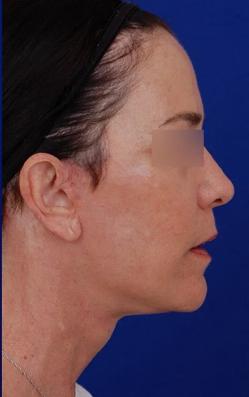 female facelift