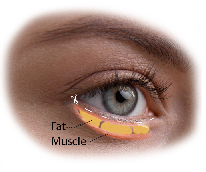 lower blepharoplasty visage facial plastic surgery