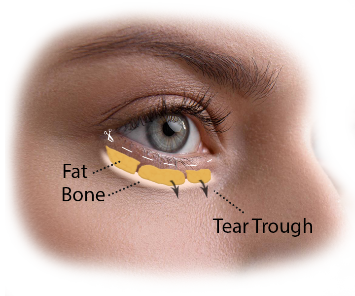 undereye fat repositioning visage facial plastic surgery