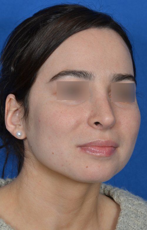 female after revision rhinoplasty