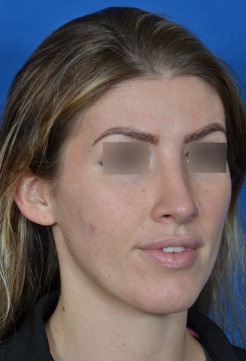 female rhinoplasty