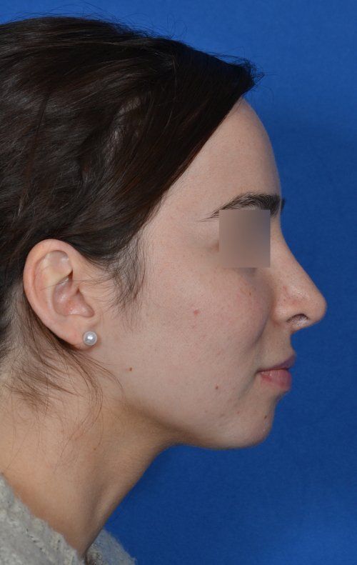 female after revision rhinoplasty