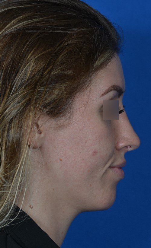 female rhinoplasty