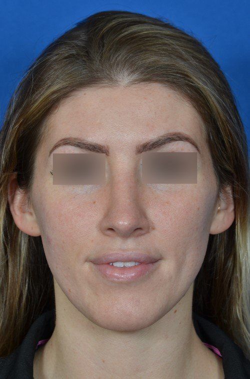 female rhinoplasty