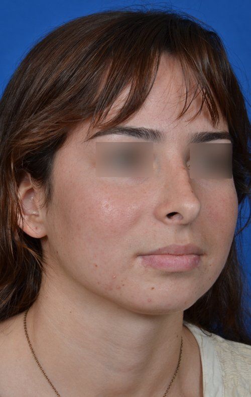 female before revision rhinoplasty