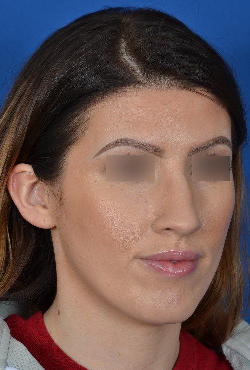 before rhinoplasty