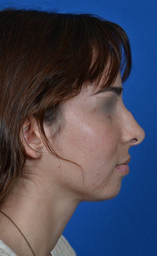 female before revision rhinoplasty