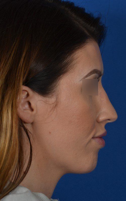before rhinoplasty