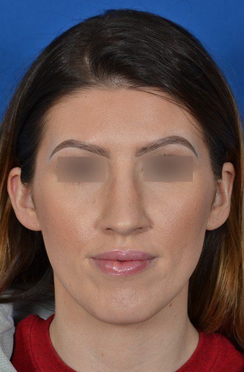 before rhinoplasty