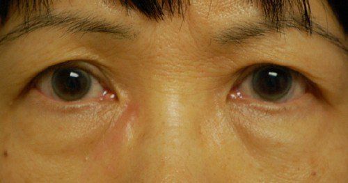 upper eyelids of woman