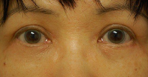 upper eyelids of woman