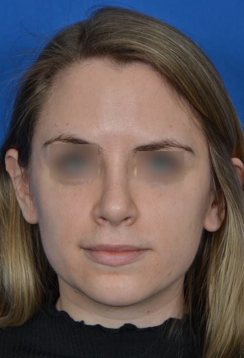 before rhinoplasty