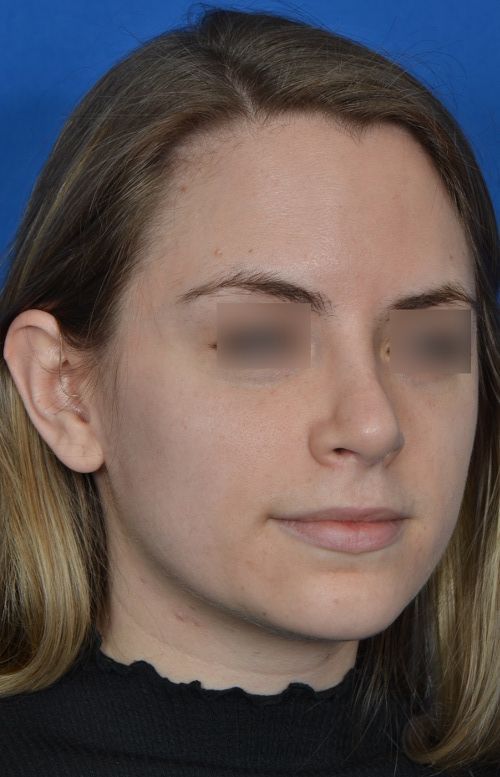 female rhinoplasty