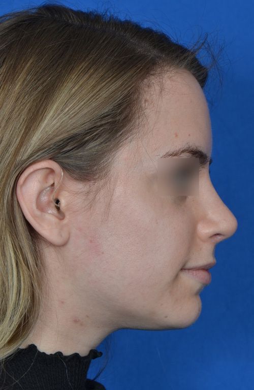 female rhinoplasty