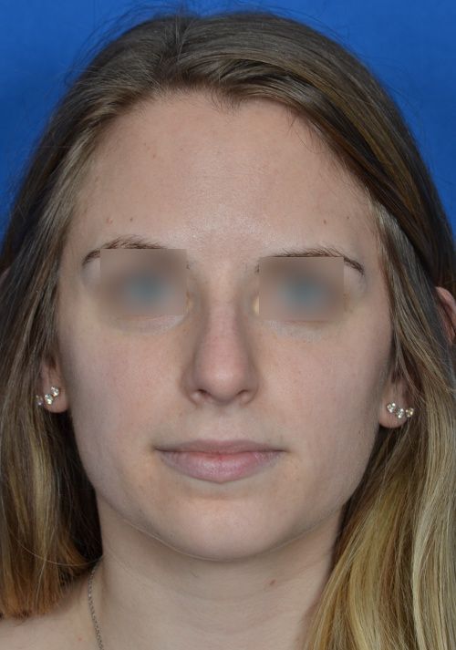 before rhinoplasty
