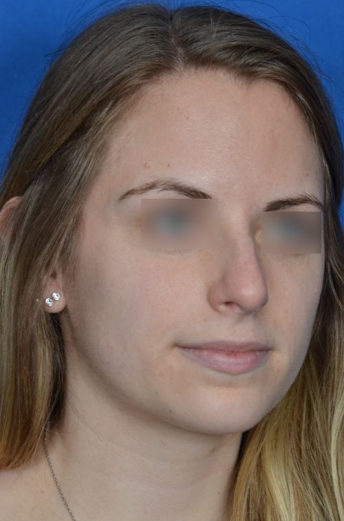before rhinoplasty