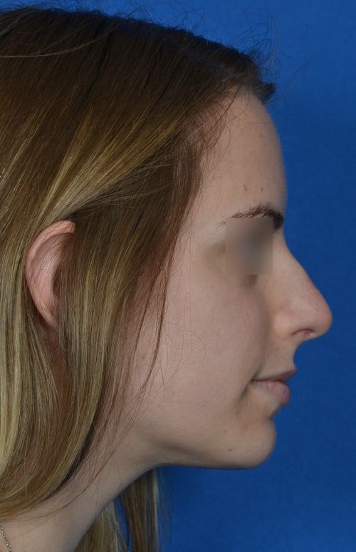 before rhinoplasty