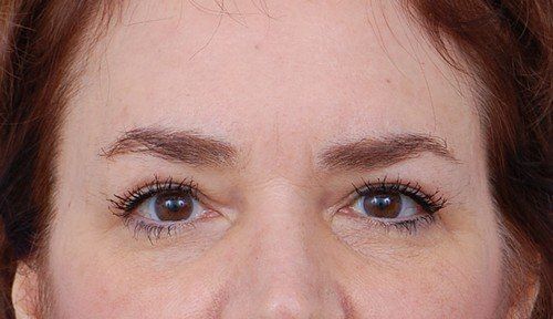 brow lift before and after