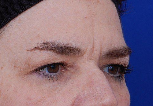 brow lift before and after