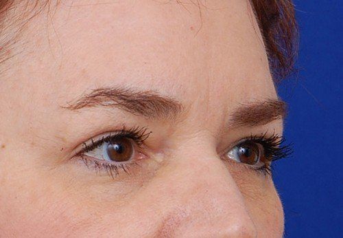 brow lift before and after