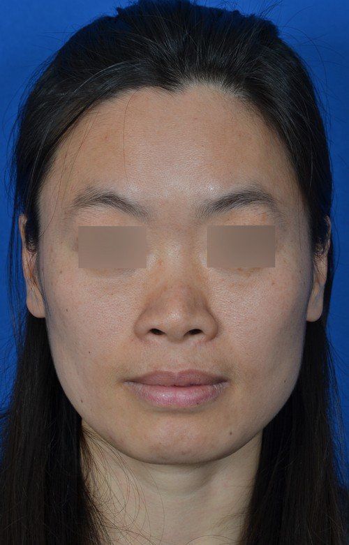 rhinoplasty