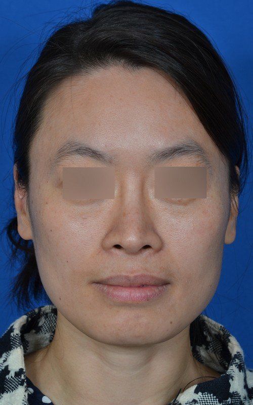 rhinoplasty