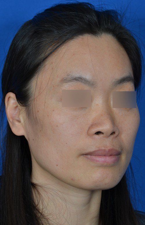 rhinoplasty
