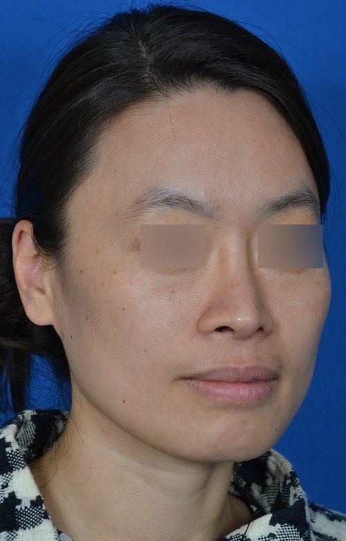 rhinoplasty