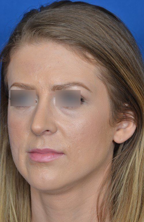 female rhinoplasty