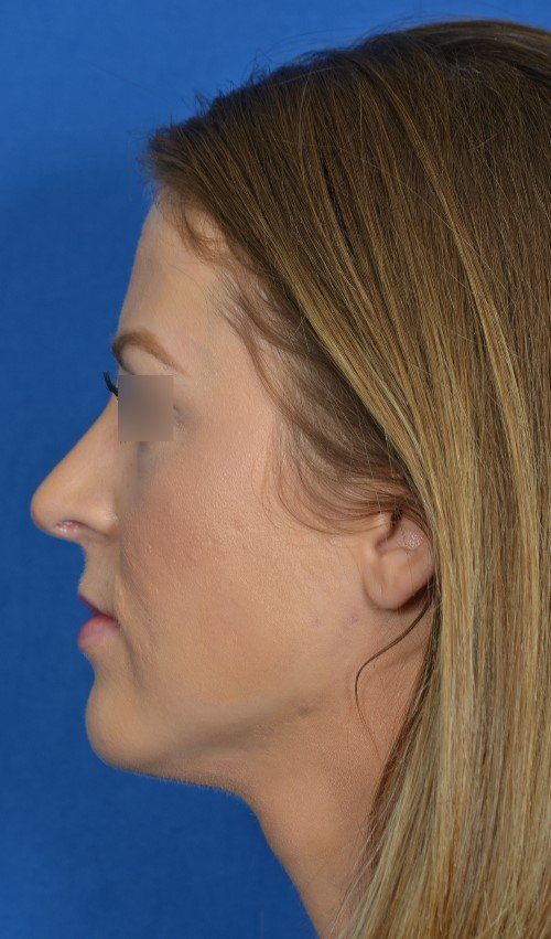 rhinoplasty side view