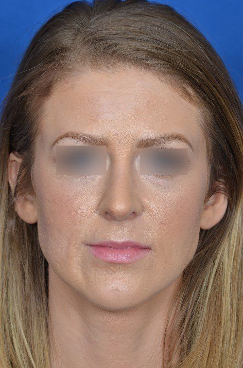 female rhinoplasty