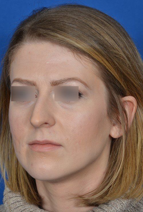 before rhinoplasty