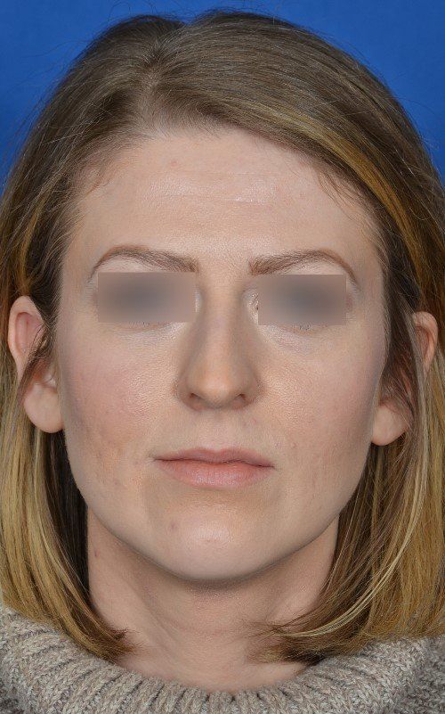 before rhinoplasty